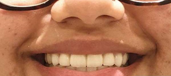 Before After Dental Treatment 1