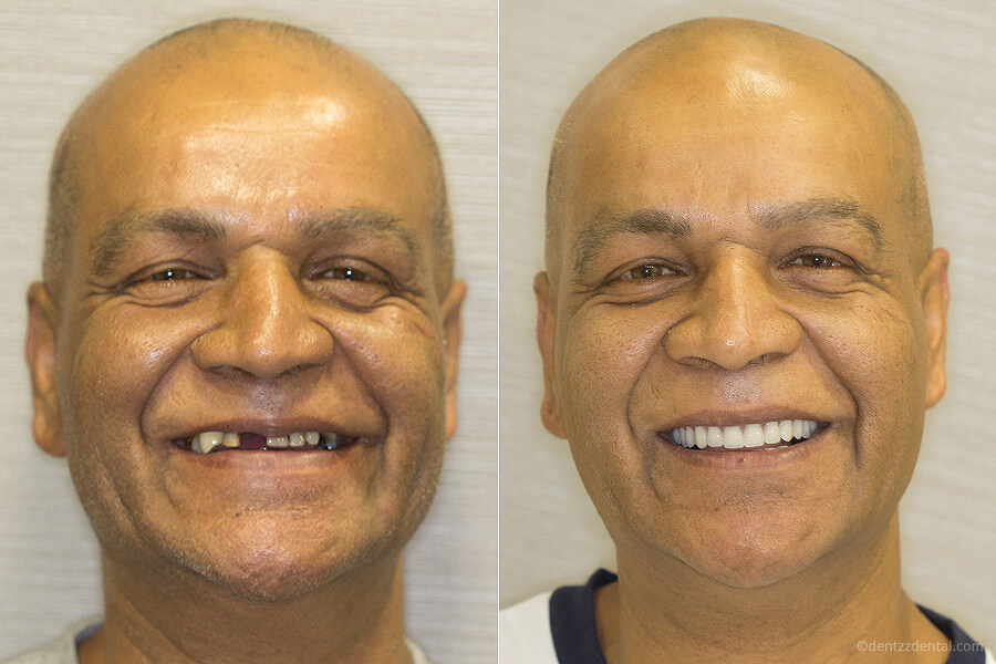 Before After Dental Treatment 3